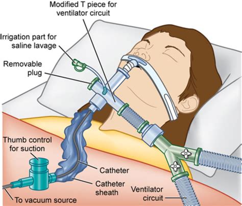 Airway Management And Mechanical Ventilation Flashcards Quizlet