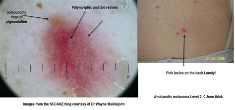 Dermoscopy Made Simple Amelanotic Melanoma