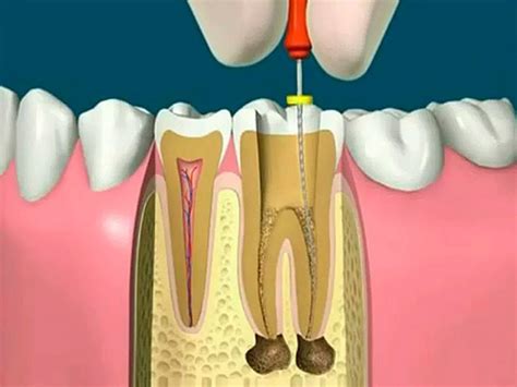 Tratamento De Canal Dentário Ortomix Odontologia Seu Dentista Em