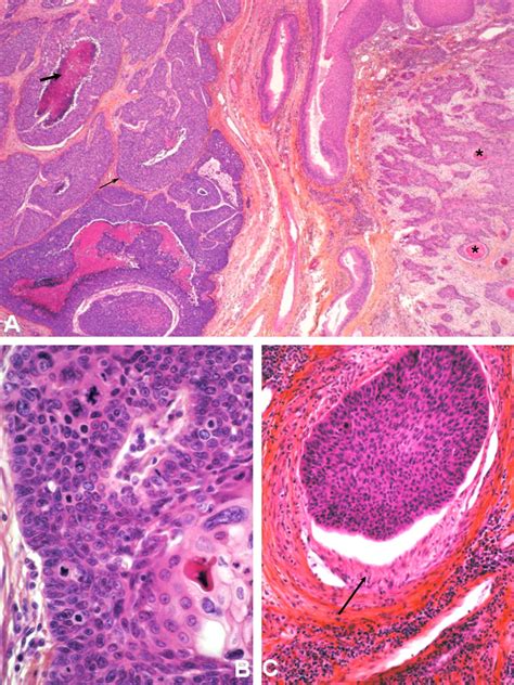 Course And Prognosis Of Basaloid Squamous Cell Carcinoma Of The Head