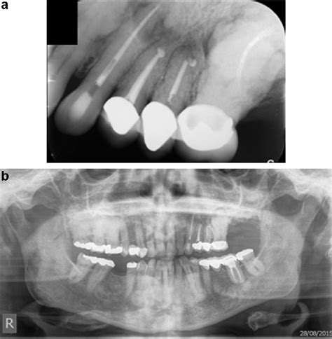 a) Intraoral periapical radiograph of the 23,24,25,26 revealing gross ...