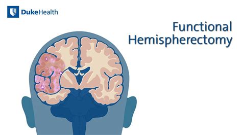 Functional Hemispherectomy | Duke Health - YouTube