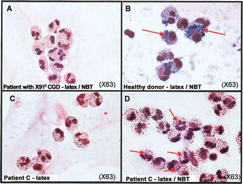 Figure 2 From Severe Clinical Forms Of Cytochrome B Negative Chronic