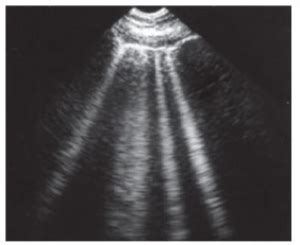 Pulmonary Edema Ultrasound