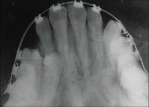 Indian Board Of Orthodontics Case Report Orthodontic Management Of A Palatally Impacted