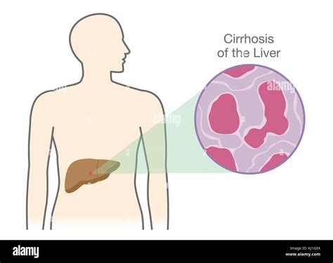 Montrant Les Cellules Endommag Es La Cirrhose Du Foie De Personnes