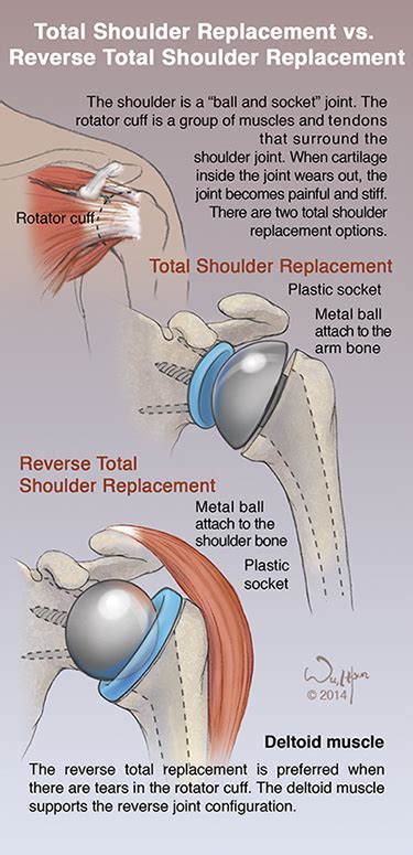 Patient Education Total Shoulder Replacement Vs Reverse Total Shoulder Replacement I Hsun Wu