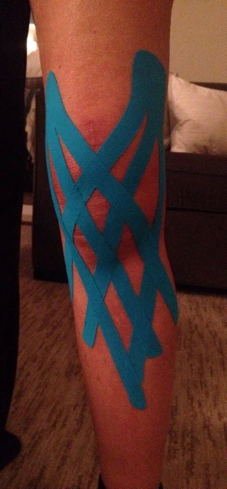 Kinesio Tape for Swelling