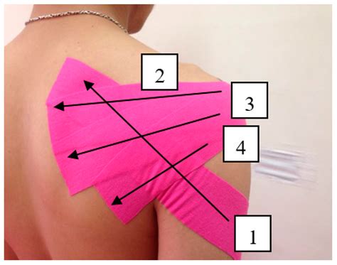 Medicina Free Full Text Comparison Of The Acute Effects Of Kinesio