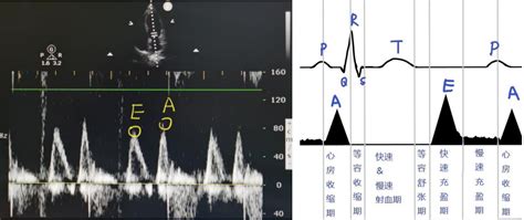 心脏超声报告不会看？先熟记这 6 大指标！ 丁香园