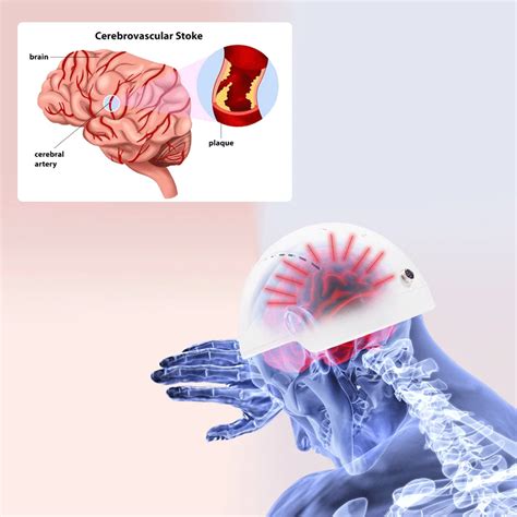 Aumento Do Fluxo Sangu Neo Cerebral 810nm Pdt Transcranial Estimula O