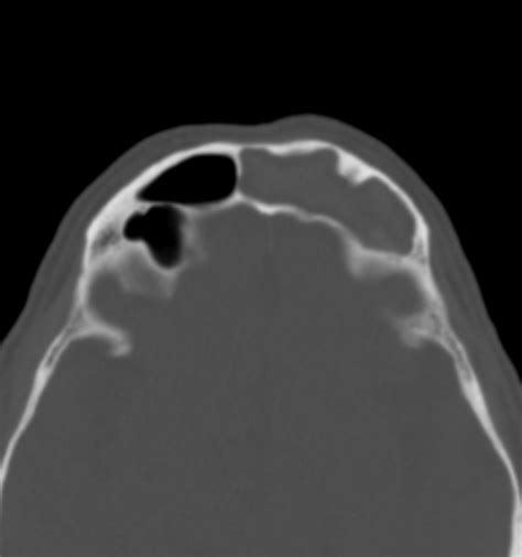 Allergic Fungal Sinusitis Image