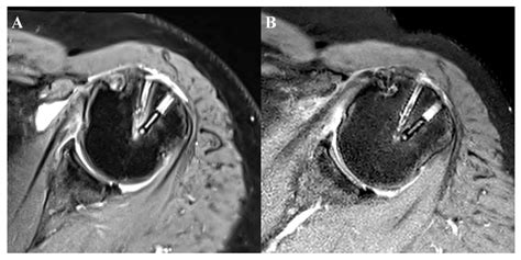 Jcm Free Full Text Clinical And Radiologic Outcomes Of Combined Use Of Biocomposite And Peek