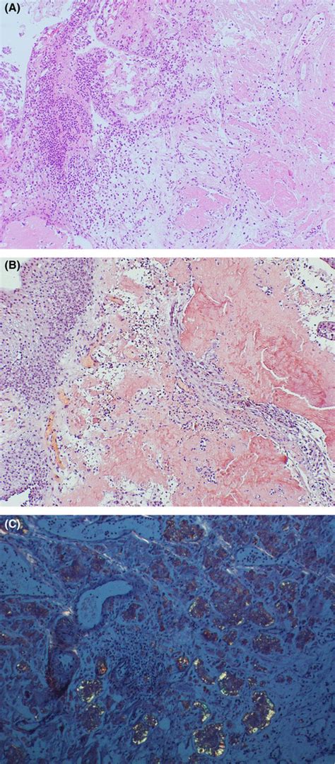 Primary Bladder Amyloidosis Mimicking Bladder Cancer Complicated By Bladder Rupture A Case