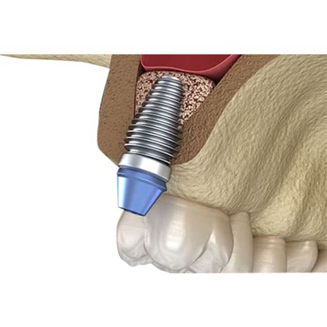 Sinus Lift Surgery Kalmar Implant Dentistry