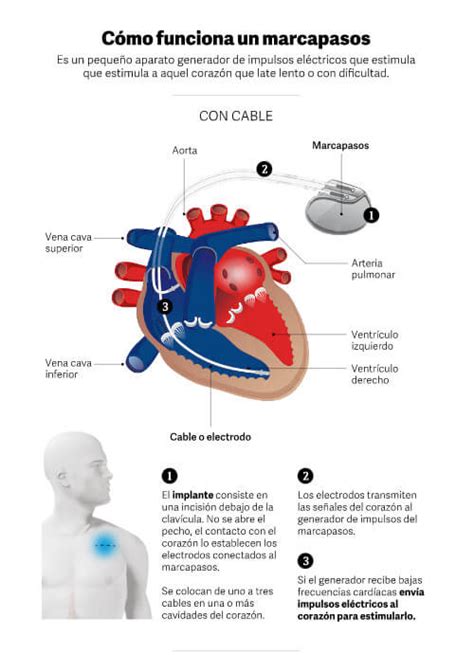 Marcapasos Cardíaco Qué Es Cómo Funciona Y En Quiénes Se Indica Este Dispositivo