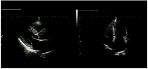 Case Report A Case Of Dilated Cardiomyopathy