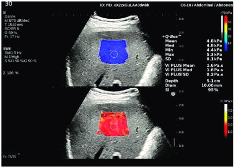 Illustration Of A Two Dimensional Shear Wave Elastography 2D SWE And