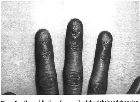 Figure 1 from Lichen Planus Localized to the Nails | Semantic Scholar