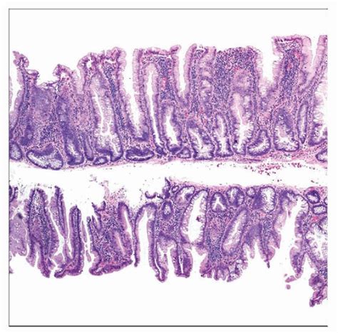 Sessile Serrated Adenoma Histology