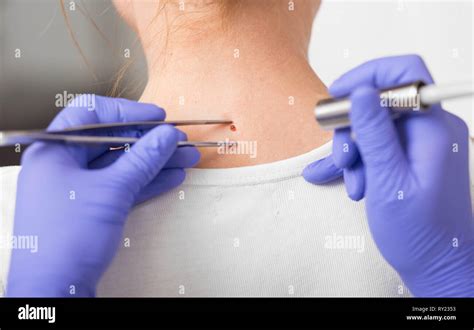 Skin Moles Treatment Laser Mole Removal At Clinic Stock Photo Alamy