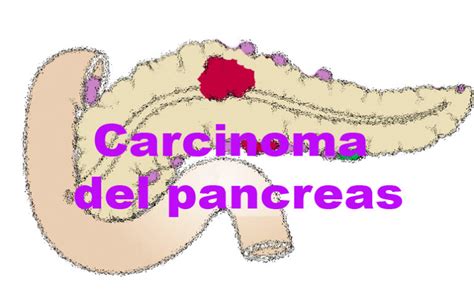 Carcinoma Del Pancreas Intraduttale Mucinoso Papillare