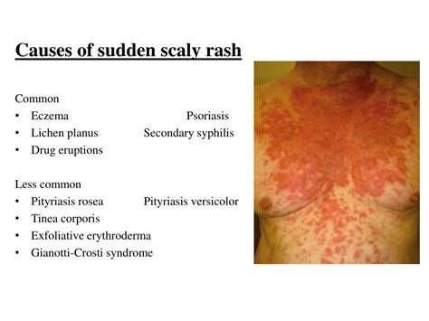 Ppt Papulosquamous Disorders Powerpoint Presentation Free Download