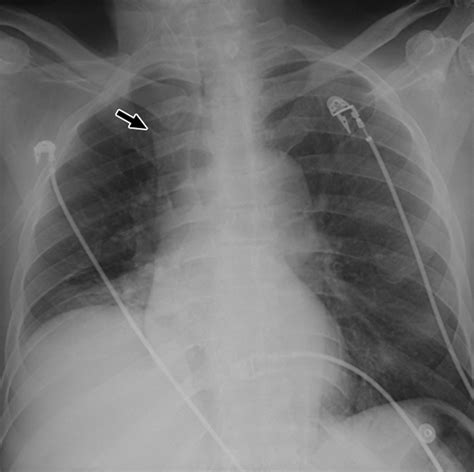 Chest Radiography In Thoracic Polytrauma Ajr