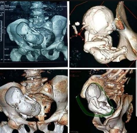 Lithopedion Stone Baby Is A Rare Phenomenon Which Occurs When A Fetus