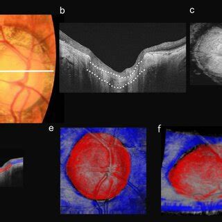 Color fundus photograph and OCT images of a 55-year-old highly myopic ...