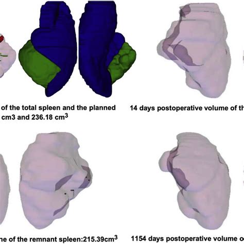 Dynamic Contrast Enhanced Multidetector Computed Tomography Ct Scan