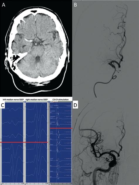 Illustrative Case Of A Patient Presenting With Right Sided Hemiplegia