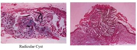 Histology Periapical Cyst