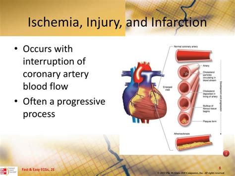 Ppt Myocardial Ischemia Injury And Infarction Powerpoint