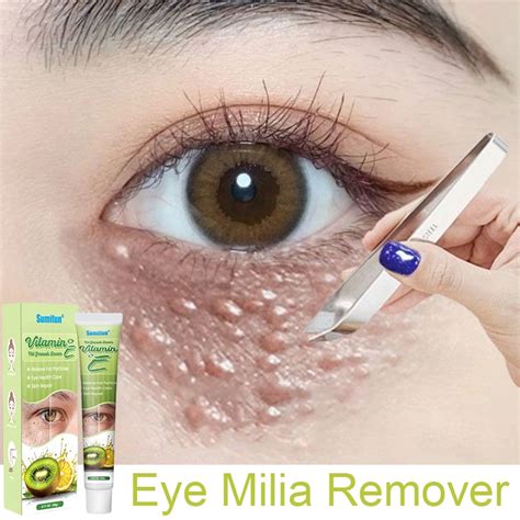 Jual Krim Penghilang Milia Syringoma Xanthelasma Butiran Lemak Sekitar Mata Shopee Indonesia