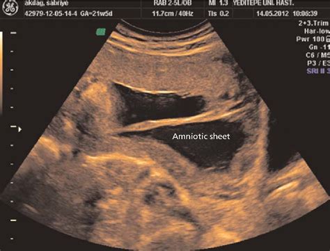 Icd Code Of Amniotic Band Syndrome And Icd Code Hot Sex Picture