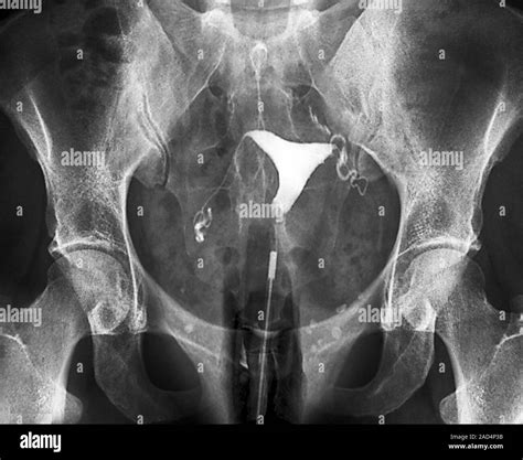 Hysterosalpingogram X Ray Of The Pelvis Of A 27 Year Old Woman Showing