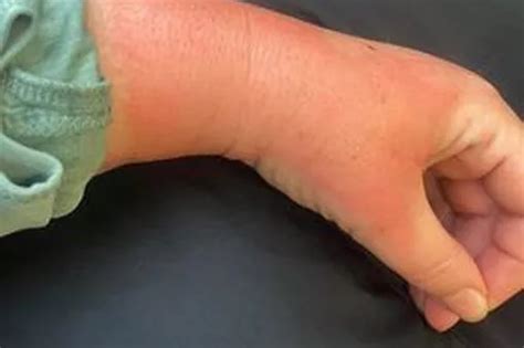 Mum In Unbelievable Pain After Out Of Date Hot Water Bottle Explodes Liverpool Echo