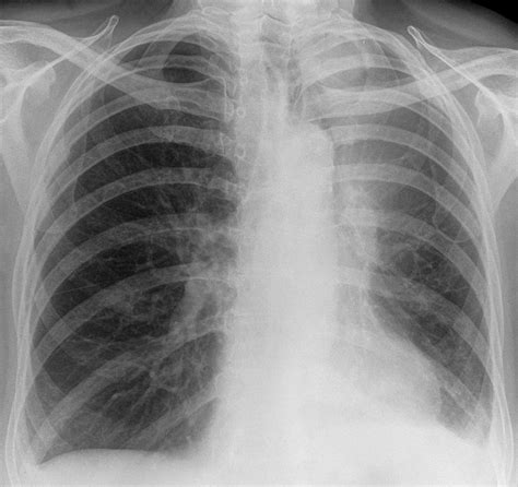 Abnormality On A Plain Film Chest Radiograph The BMJ