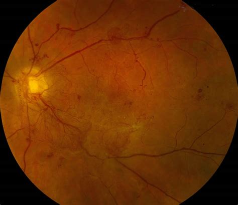 Vitreous hemorrhage causes, symptoms, diagnosis, treatment & prognosis