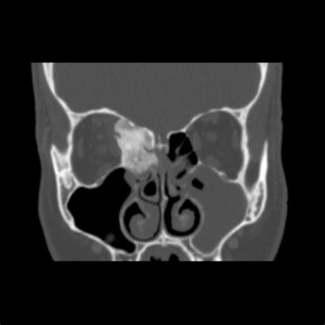 Post Gad: Sinus Osteoma