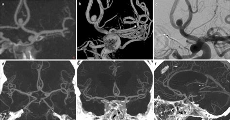 Comparison Of Ultra High Resolution And Normal Resolution CT