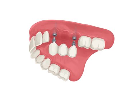 Dental Implants What Are Some Alternatives To Dental Implants