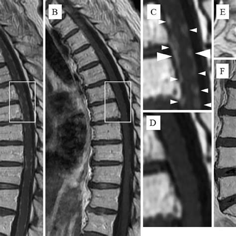 Figure1.A: MRI of the thoracic spinal cord on admission. Sagittal ...