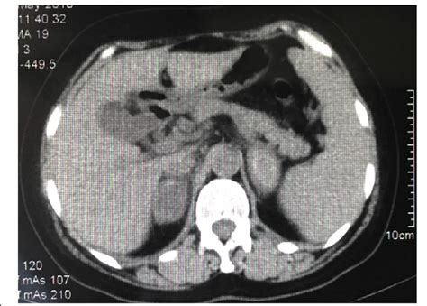 Axial Computed Tomography Scan Abdominal Postoperative Day 12