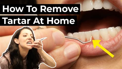 How to Remove Tartar from Teeth at Home - TheDentech.com