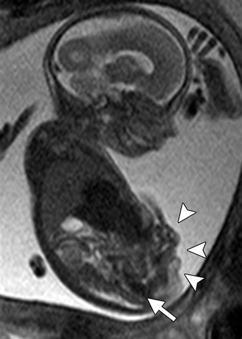 Complex Abdominal Wall Defects Appearances At Prenatal Imaging