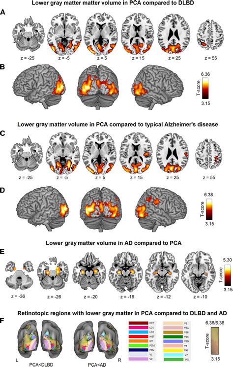 Gray Matter Volume Loss In Pca Versus Patient Control Groups The T