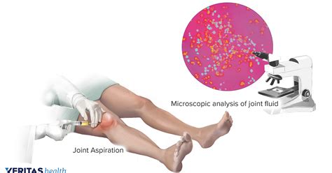Diagnosis through Synovial Fluid Analysis