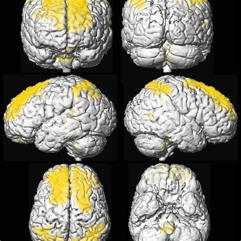 Cortical Regions Of Significantly Reduced Regional Grey Matter Volume